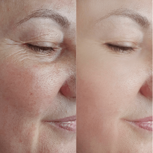 Transformação impressionante da Renata, depois de 5 semanas usando o colágeno com Blend Origins8.