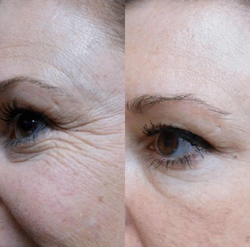 Transformação impressionante da Renata, depois de 5 semanas usando o colágeno com Blend Origins8.