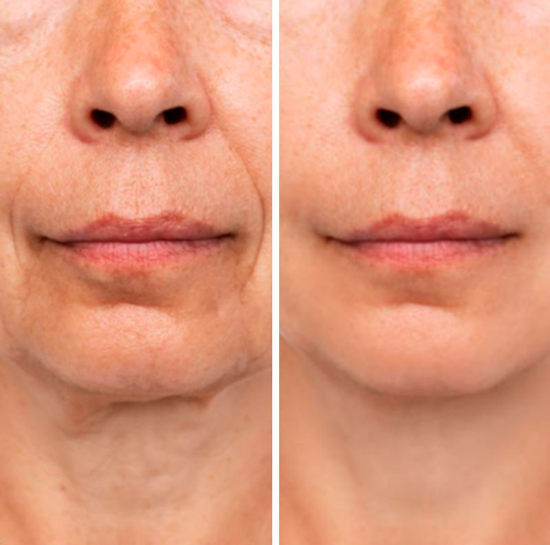 Transformação impressionante da Renata, depois de 5 semanas usando o colágeno com Blend Origins8.